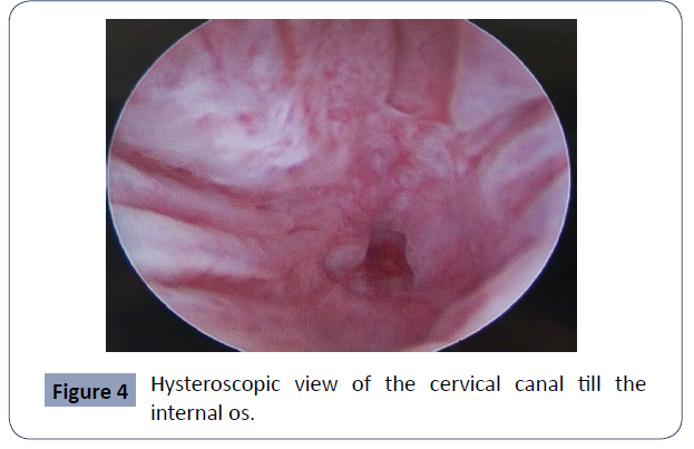 reproductive-endocrinology-infertility-Hysteroscopic