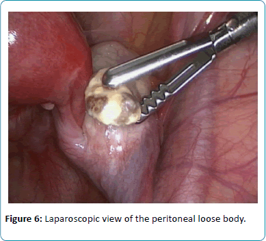 reproductive-endocrinology-infertility-Laparoscopic-view-peritoneal