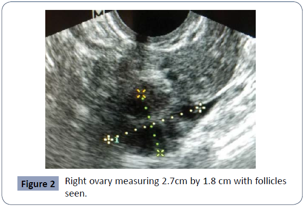 reproductive-endocrinology-infertility-follicles